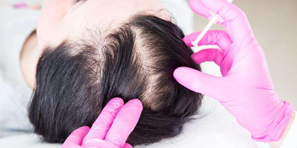 Best Hair Loss Treatment in Islamabad – Enfeild Royal Clinic in Islamabad.