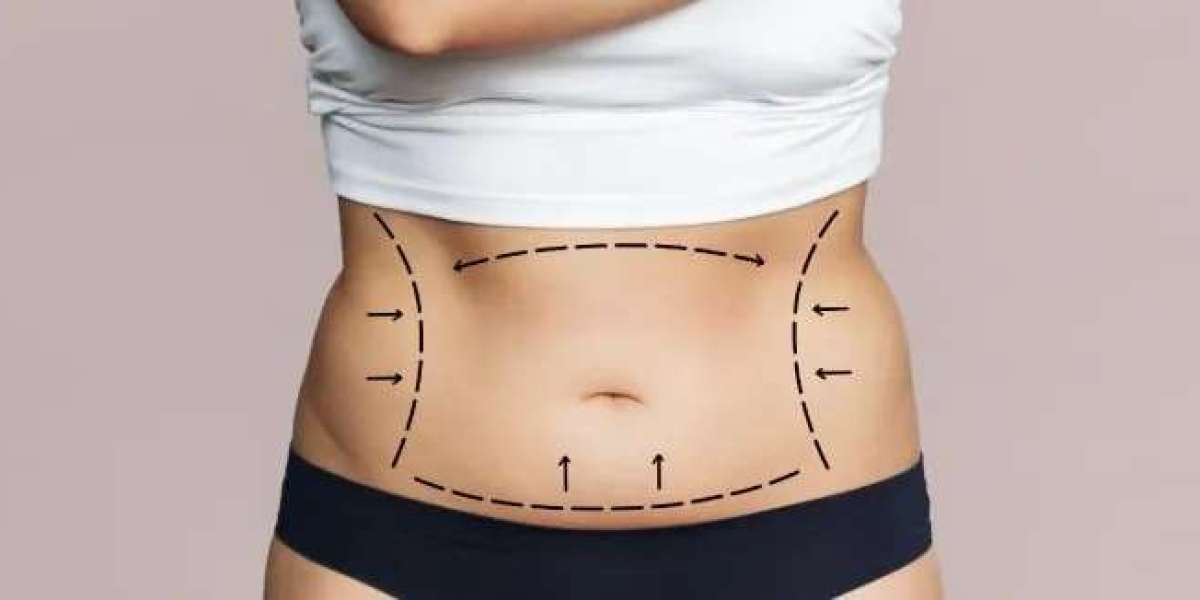 Find The Top Benefits of Tummy Tuck Surgery in Islamabad