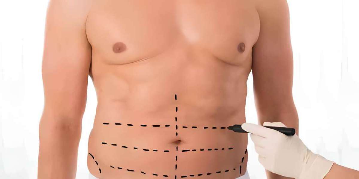 How Liposuction Surgery Helps Achieve a Sculpted Body
